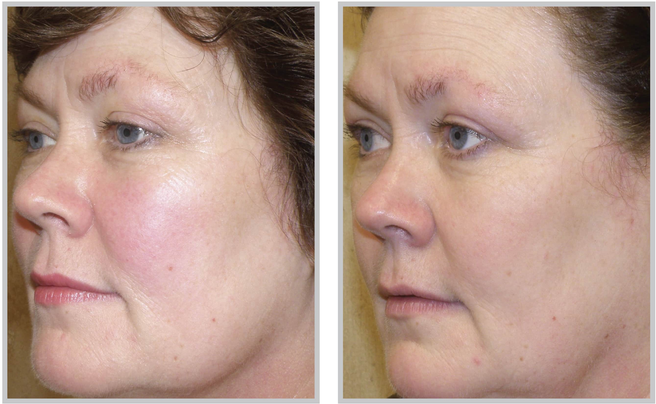 BBL Treatment for dry eye