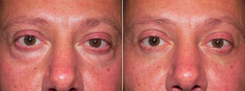Before and After Treatment