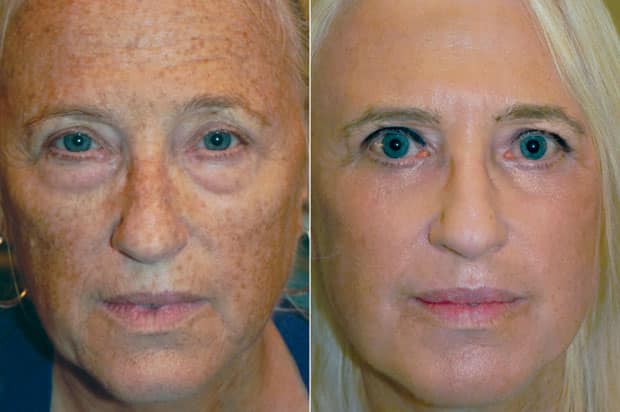Reset For Sun Damage treatment cna reverse facial sun damage. You can see the amazing results in this before and after photo.