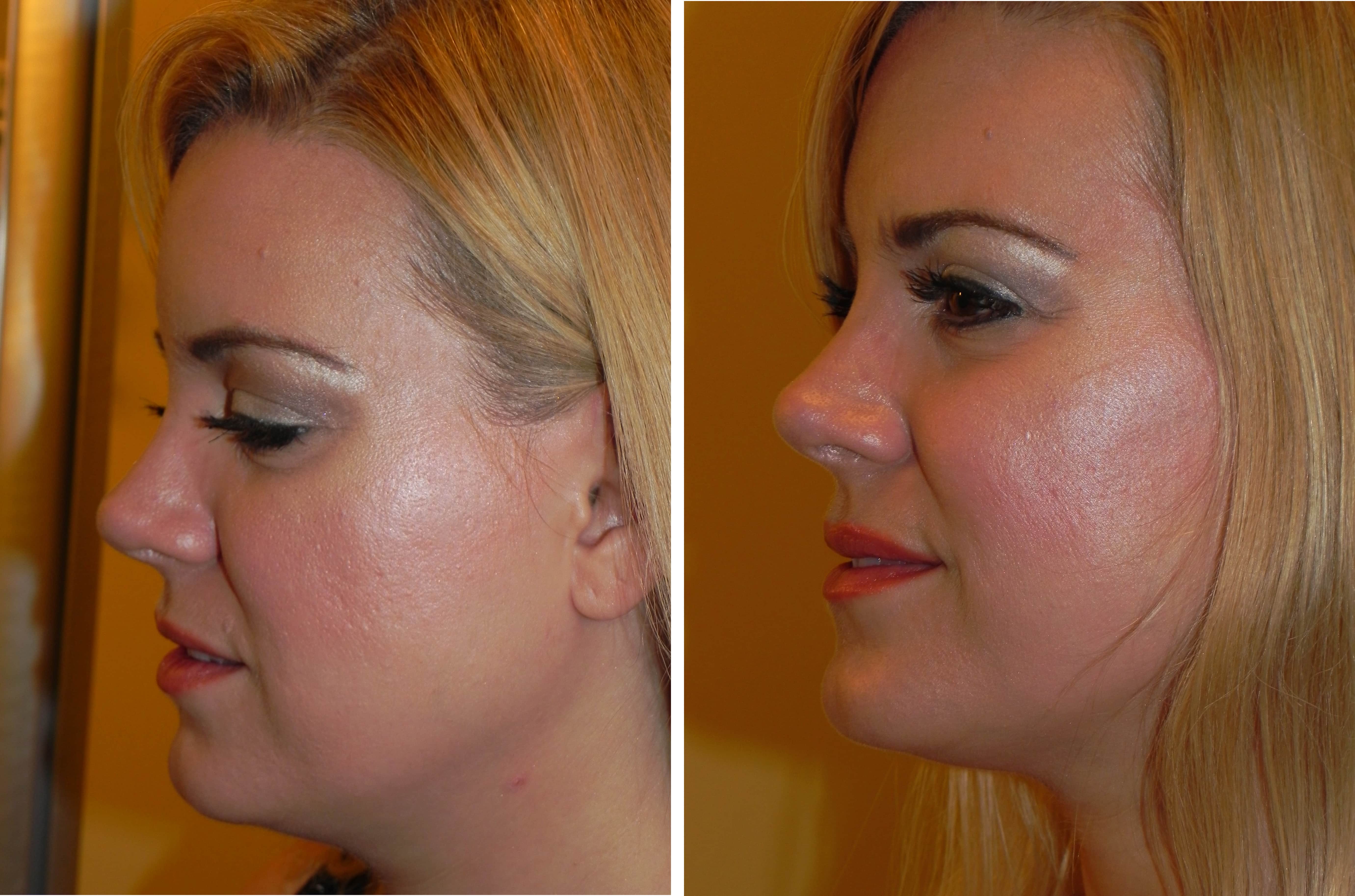 Kybella results