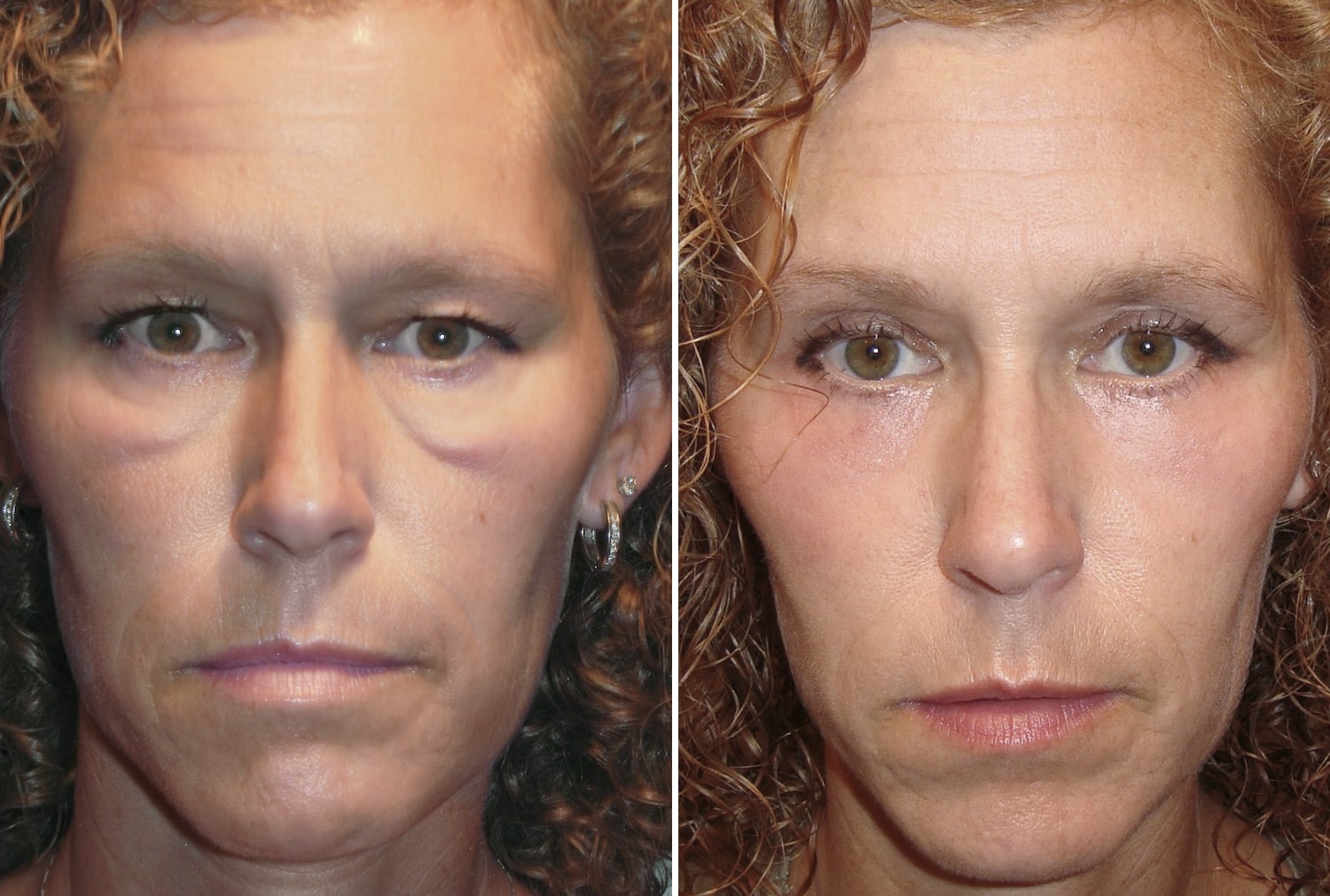 Improved lower eyelid festoons and Malar mounds