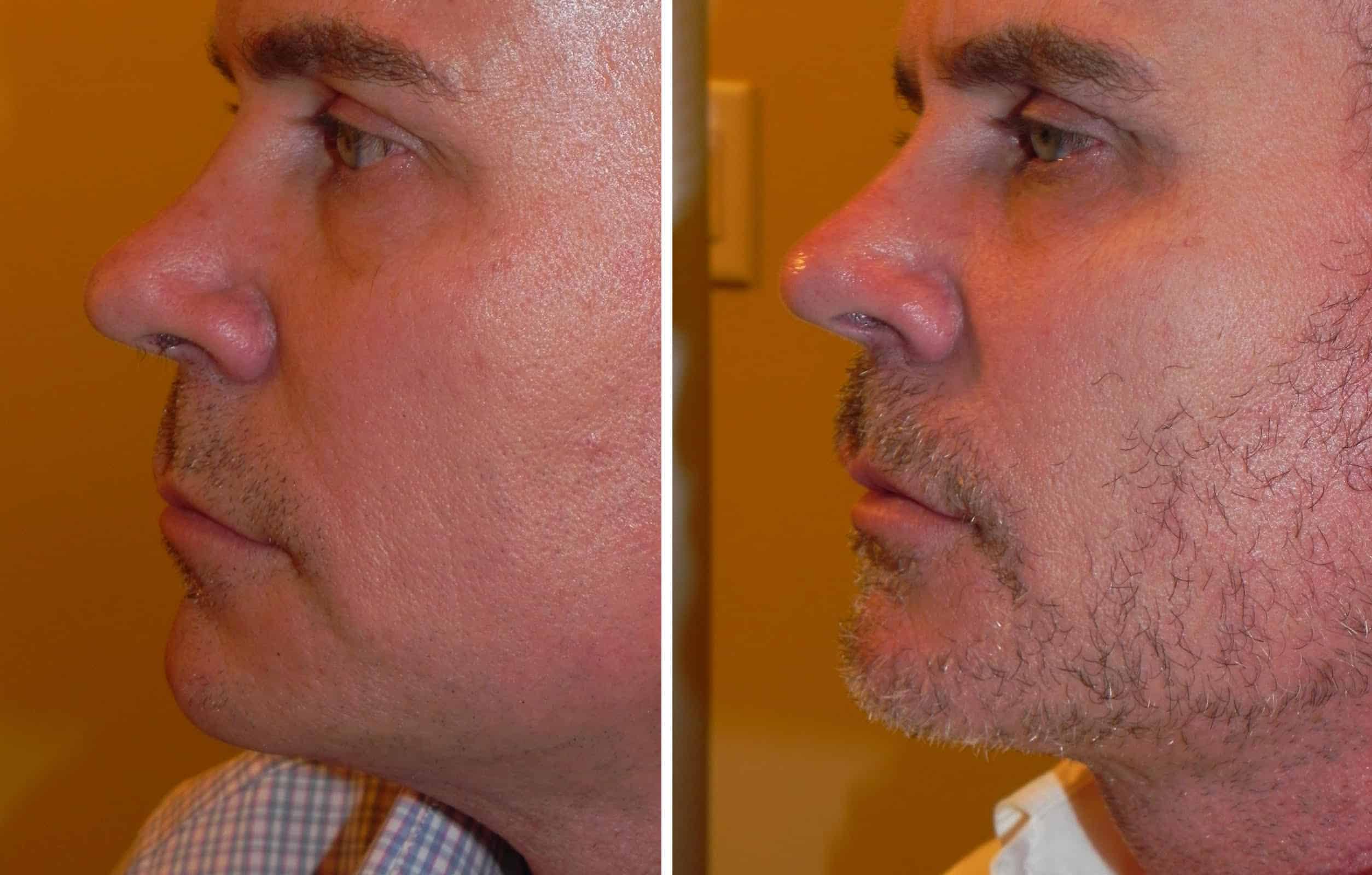 Kybella for neck fullness