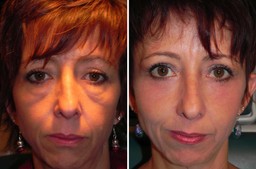 Lower eyelid bag treatment