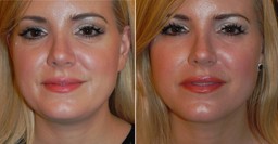 Before and After Kybella