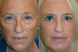 Reset For Sun Damage treatment cna reverse facial sun damage. You can see the amazing results in this before and after photo.
