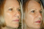 Before and After 5 Minute Nose Job
