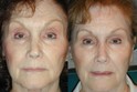 Example of Rejuvenation