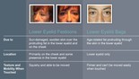 Eyelid Festoons or Eyelid Bags?