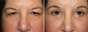 Example of Rejuvenation