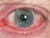 dry_eye_red_irritated