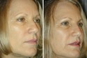 5 Minute Nose Job Photos