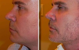 Kybella for neck fullness