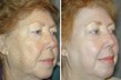 Before and After