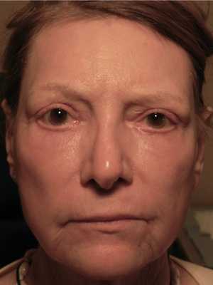 woman after eye festoon surgery