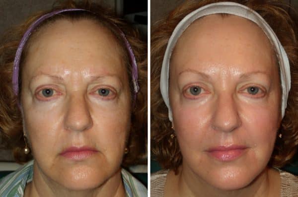 fillers to add volume in the face 