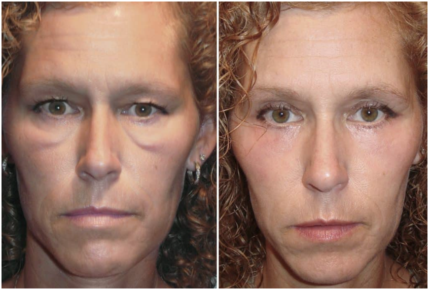 Side by side of Kara's dramatic transformation. On the left she looks sad and tired with heavy under eye bags. On the right she looks youthful and alert.