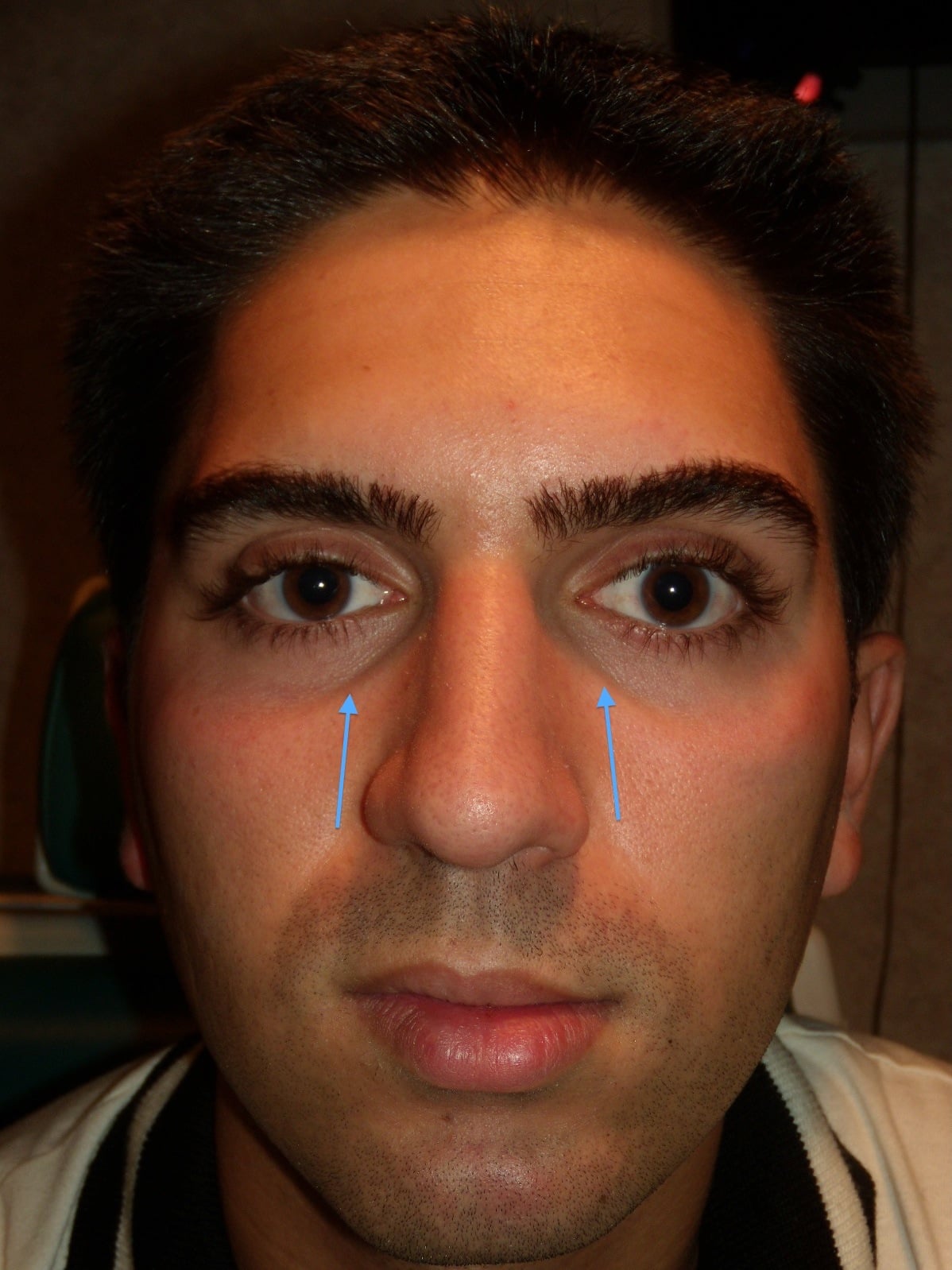 young man with hollow eyes