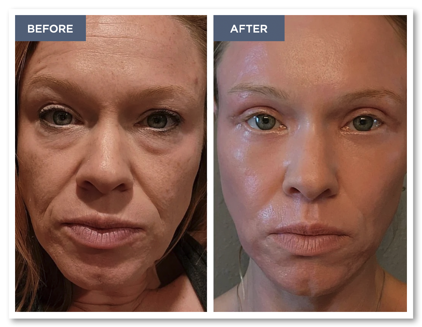 Stunning before and after showing the transformative power fo the reset procedure. The before image has deep lines, heavy eye bags, and a worn appearance. The after image has erased the lines and eye bags while giving the face a brighter, more youthful appearance.