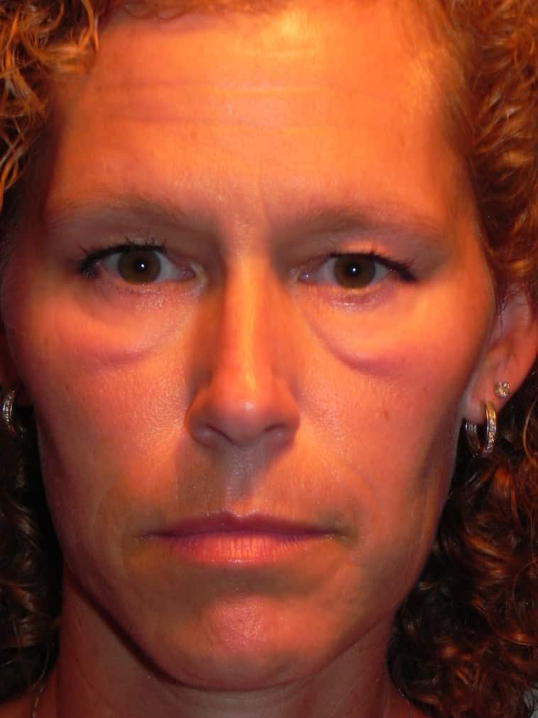 Dr. Scheiner removes festoons for patient using his RESET treatment before