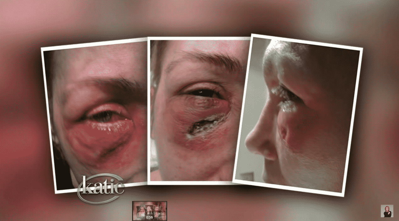 when fillers are used incorrectly