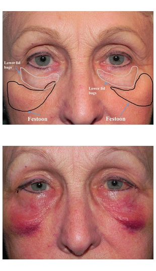 Before both eyelid surgeries