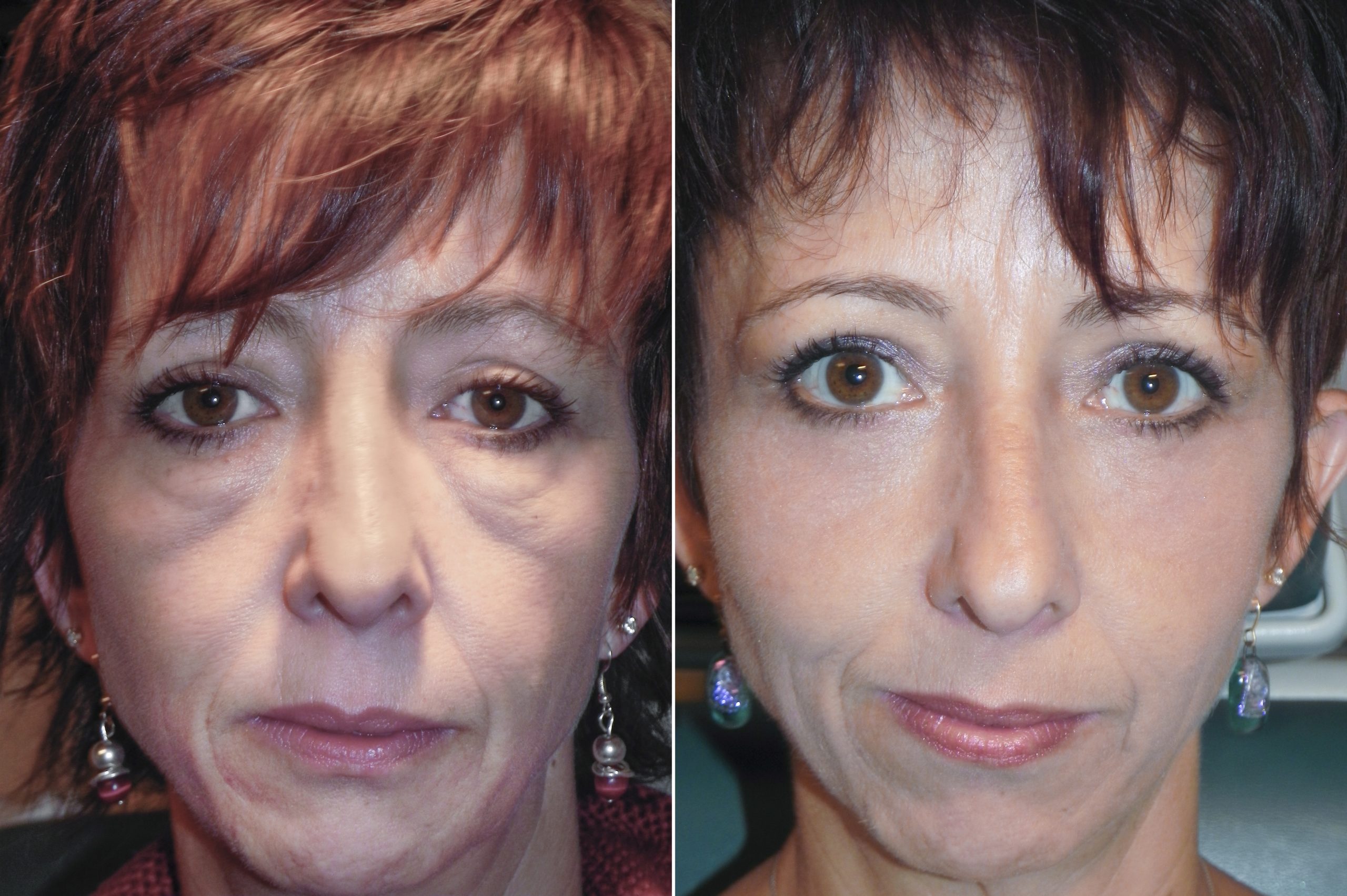 Before and after woman having festoon eye surgery