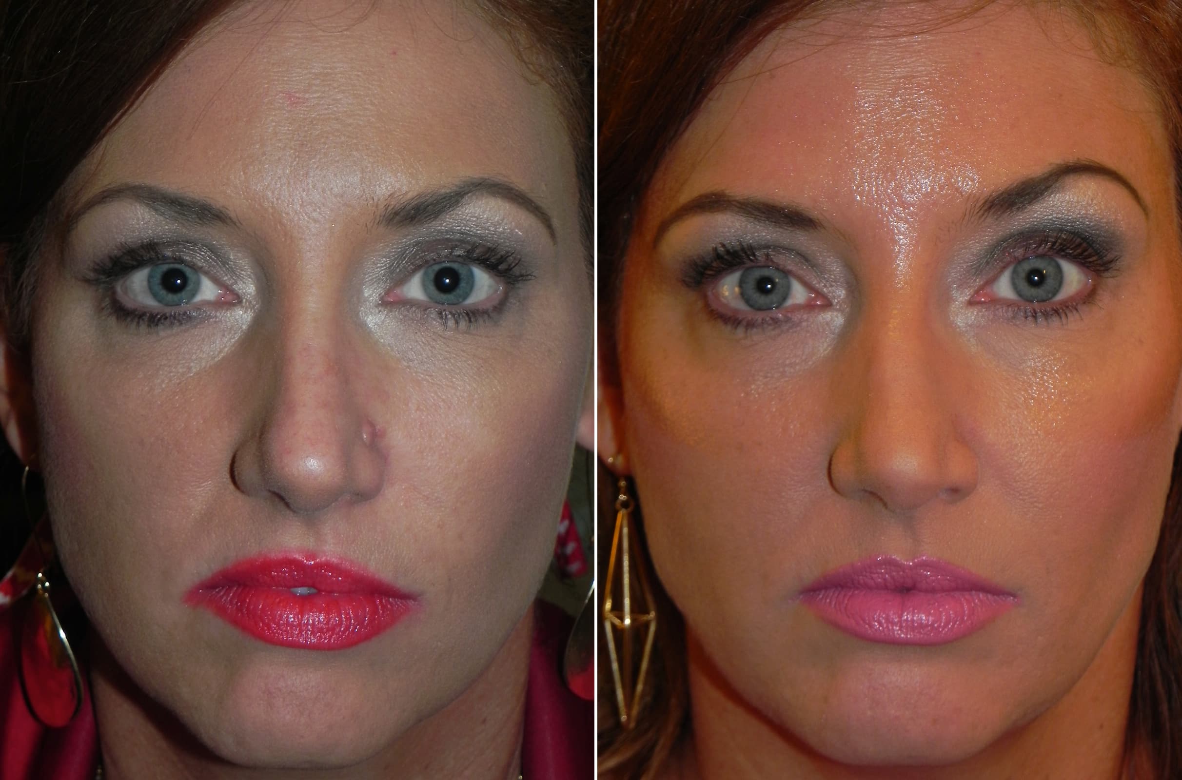 pre and post nose mole