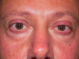 Under eye fillers and eye bags