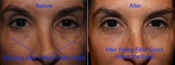 problems with fillers under the eyes