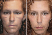 Side by side of Kara's dramatic transformation. On the left she looks sad and tired with heavy under eye bags. On the right she looks youthful and alert.