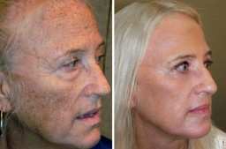 full face resurfacing