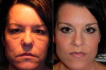 Before and after eyelid surgery