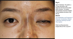 under eye fillers causing blindness