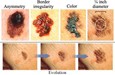 Evolution of Irregular Skin Cells