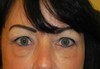 Using facial fillers under the eyes can result in an irregular appearance if done by an inexperienced practitioner. 