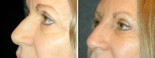 Patient Success with a 5 Minute Nose Job