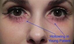 Example of good use of fillers