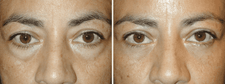 man after laser blepharoplasty