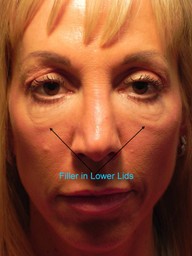 under eye filler and swelling