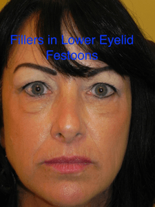 festoons caused by filler under the eye 