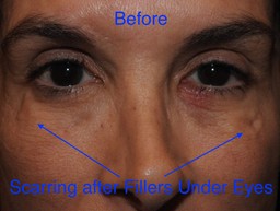 under eye filler scarring after