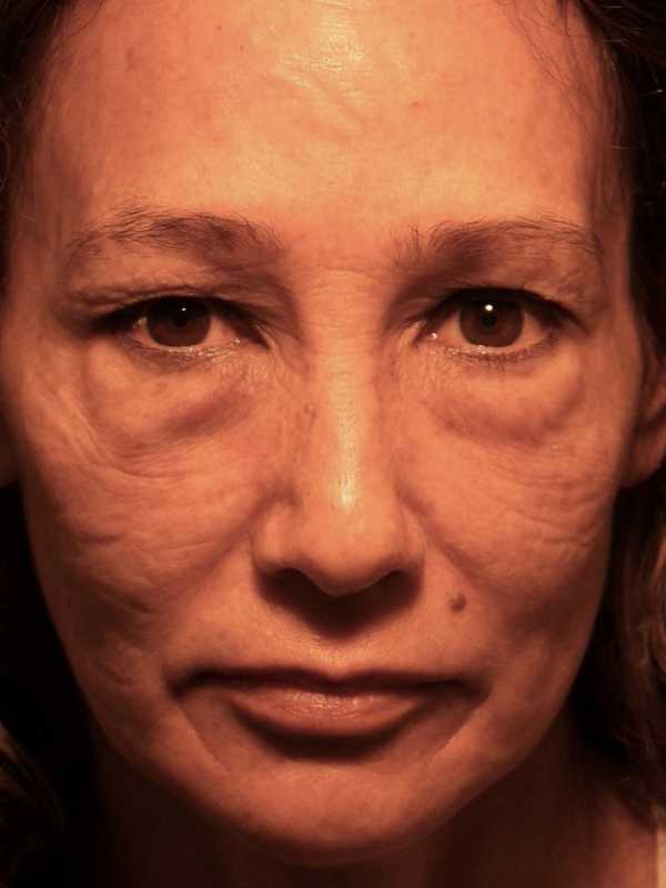 woman with malar mounds