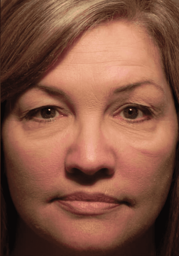 woman before eye festoons surgery