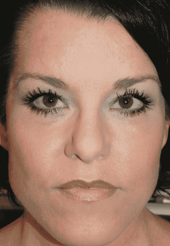 woman after RESET festoon surgery