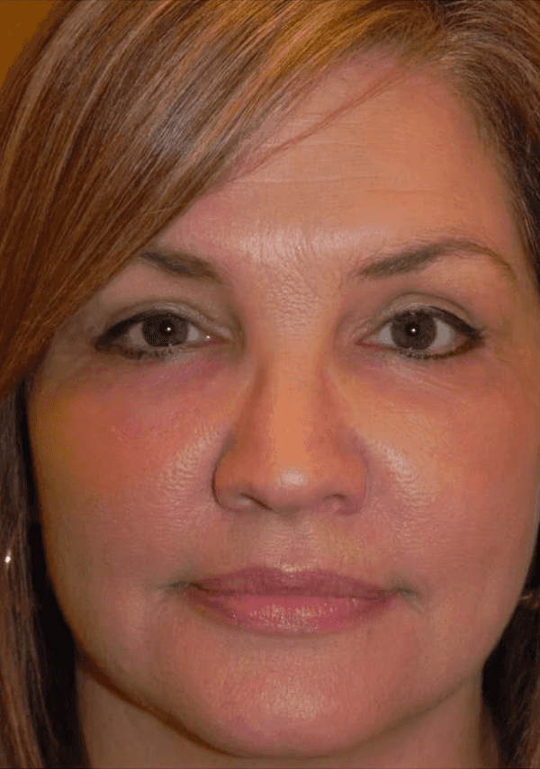 woman after surgery to remove eye festoons