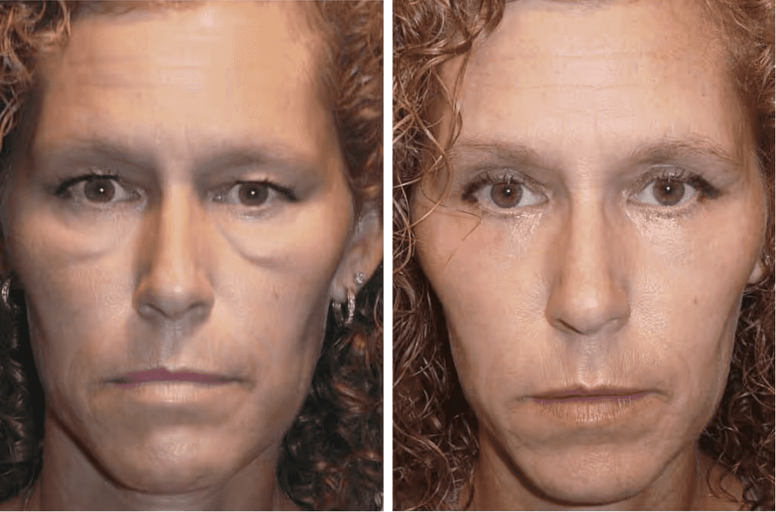 Angie before and after