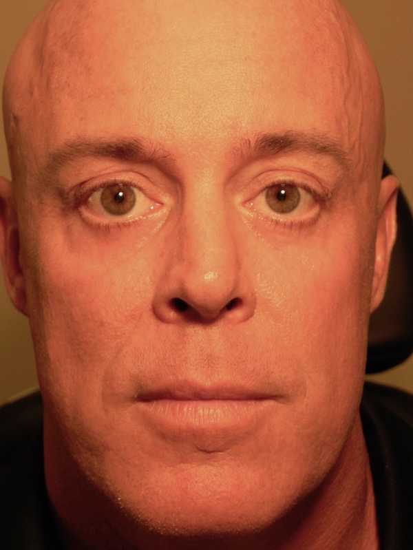 Festoons after surgery